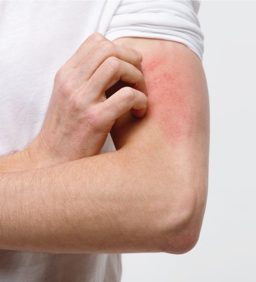 ALLERGY-TESTING